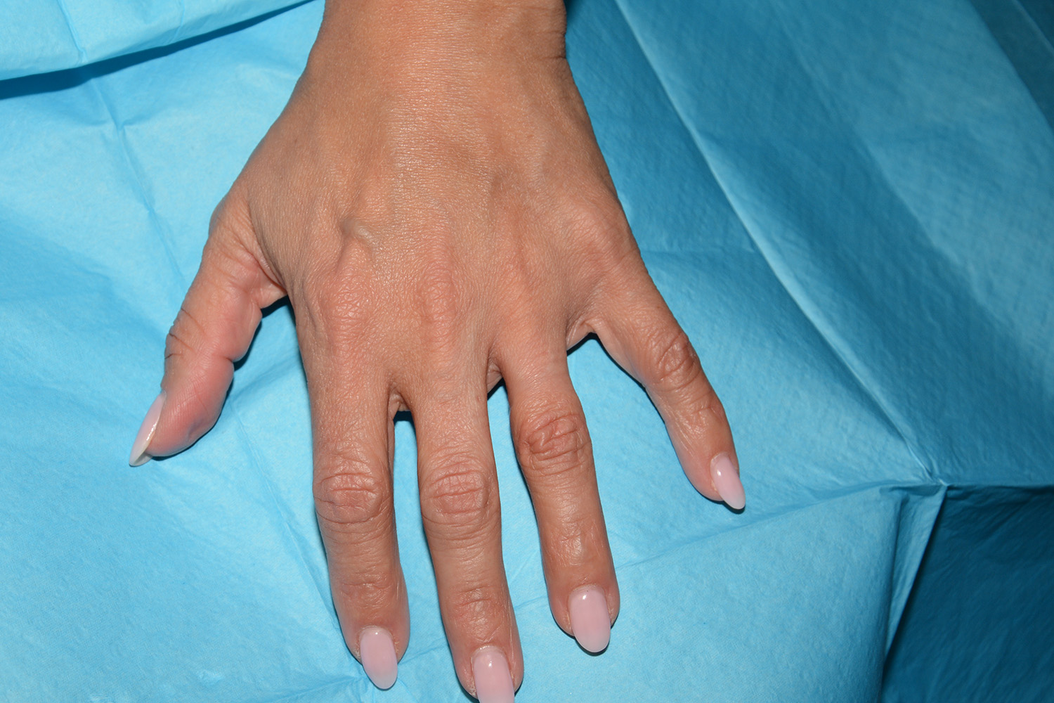 After Image: Hand Rejuvenation - front
