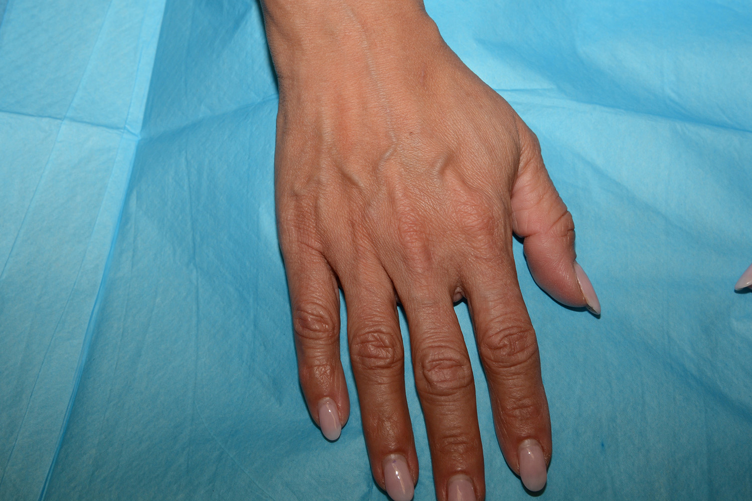 Before Image: Hand Rejuvenation - front