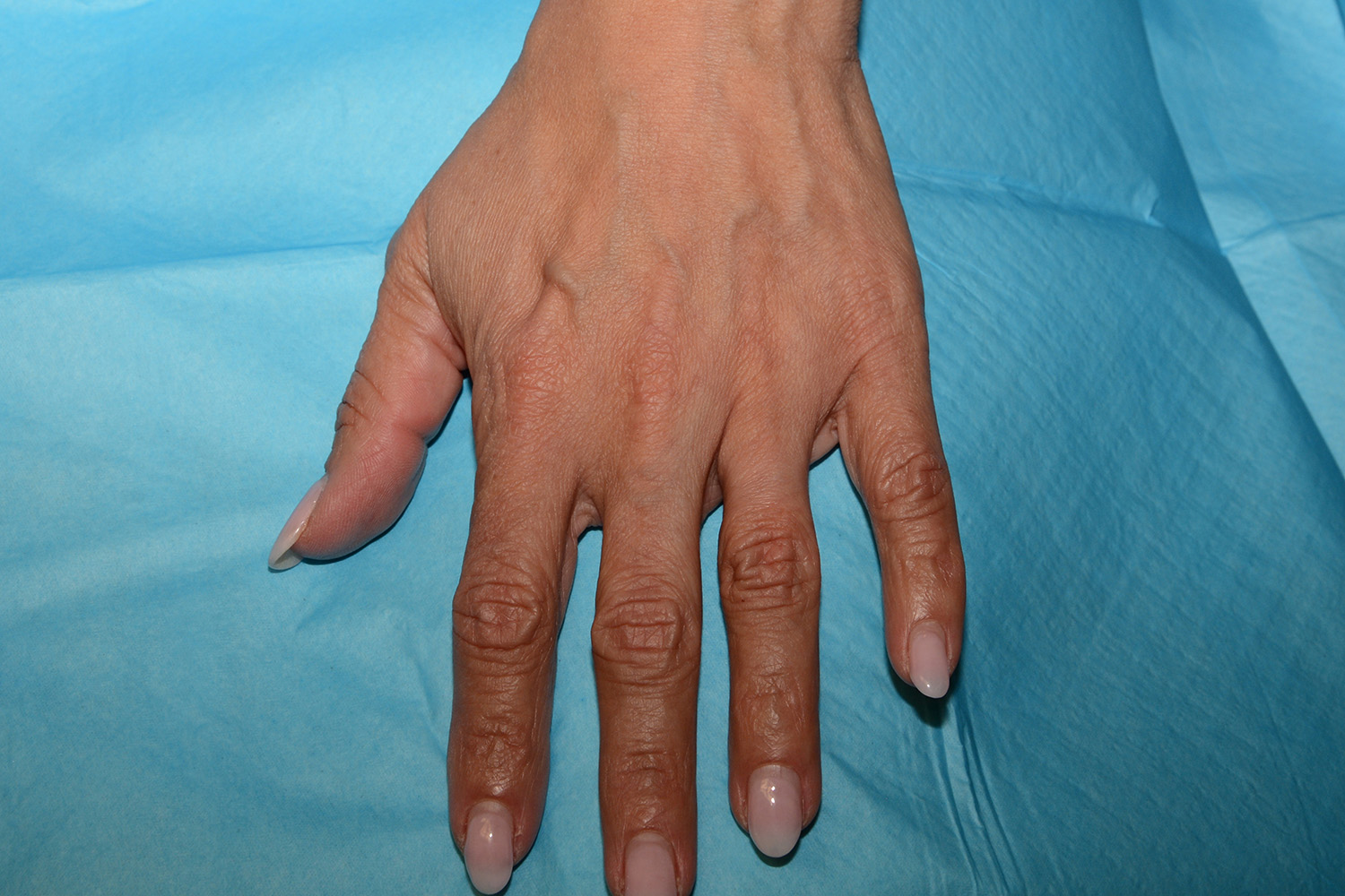 Before Image: Hand Rejuvenation - front