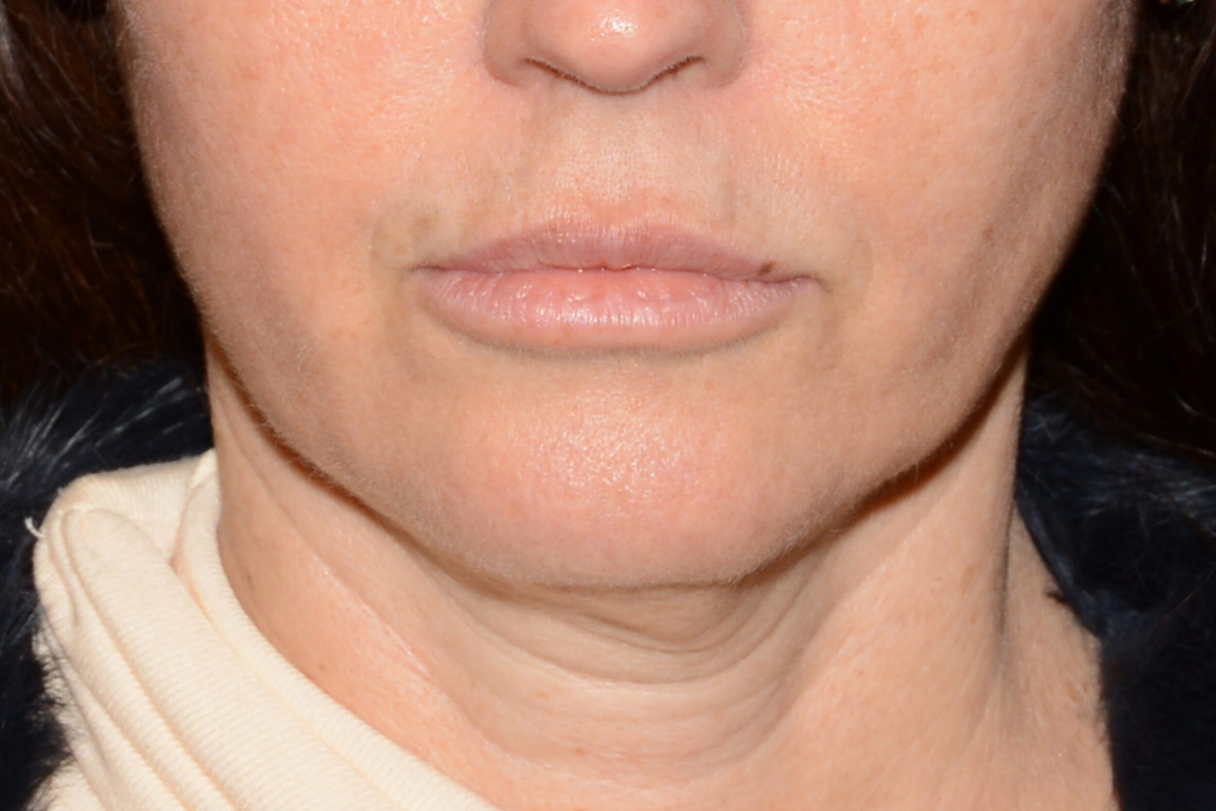 After Image: Sad Smile Correction - front