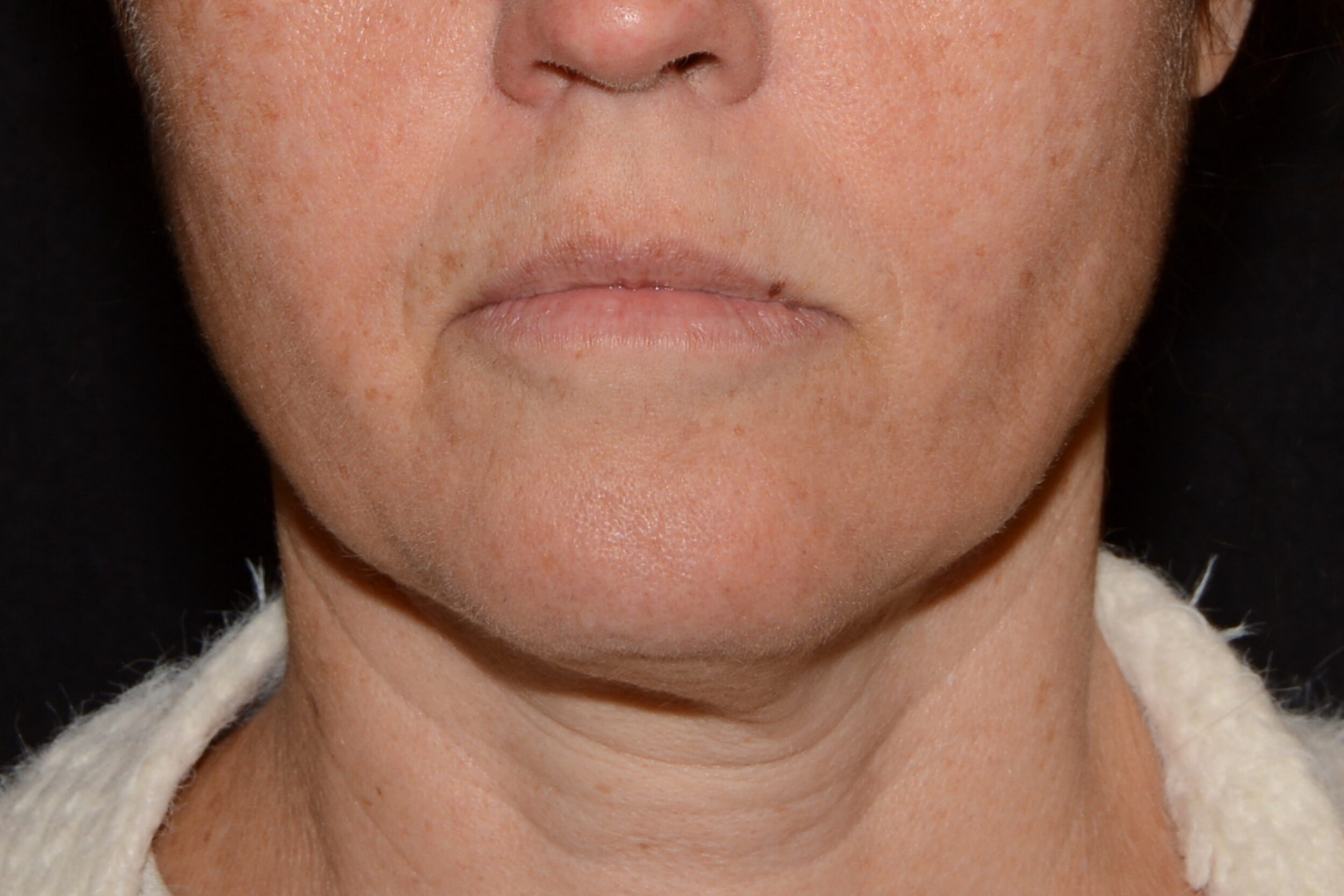 Before Image: Sad Smile Correction - front