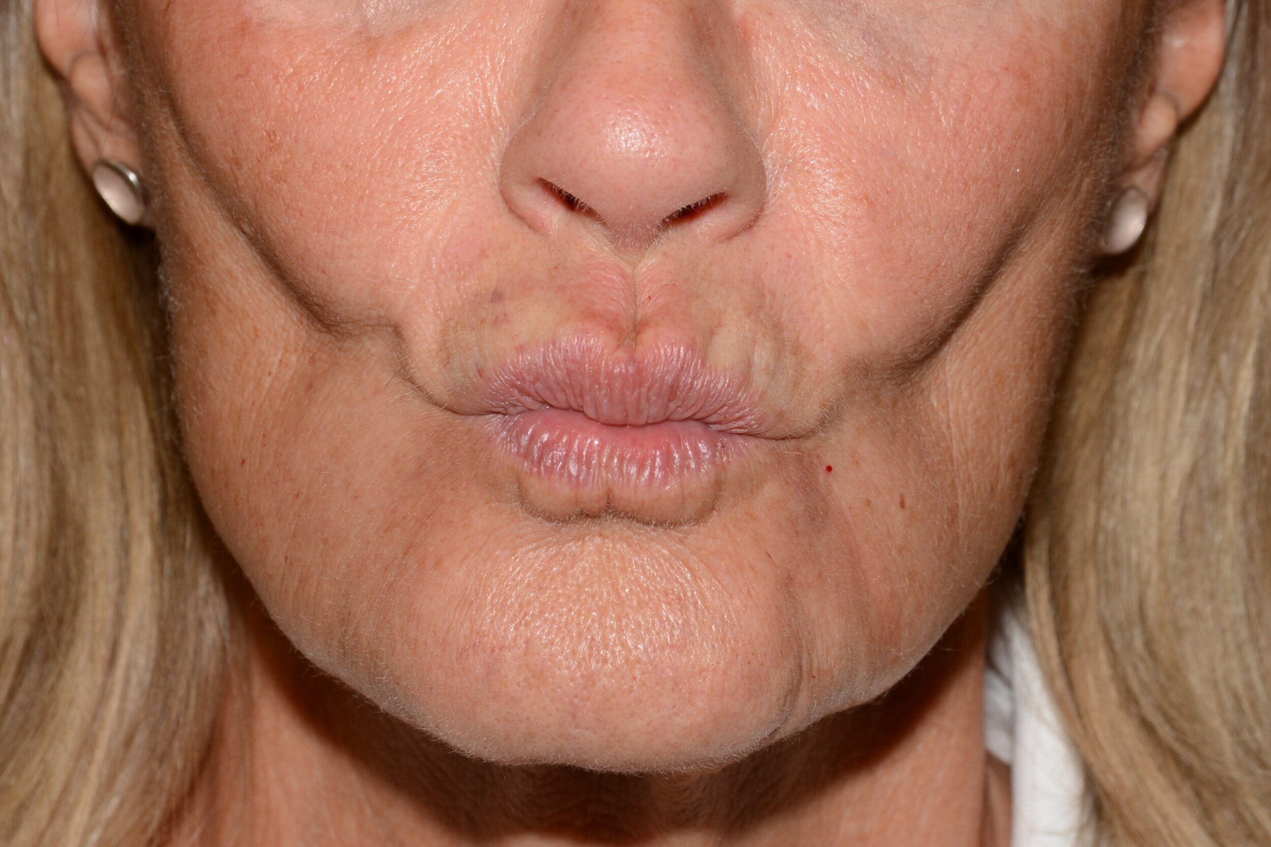 Before Image: Lip Filler - front