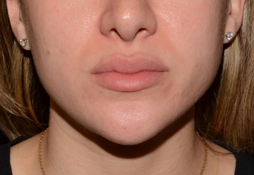 After Image: Lip Flip - front