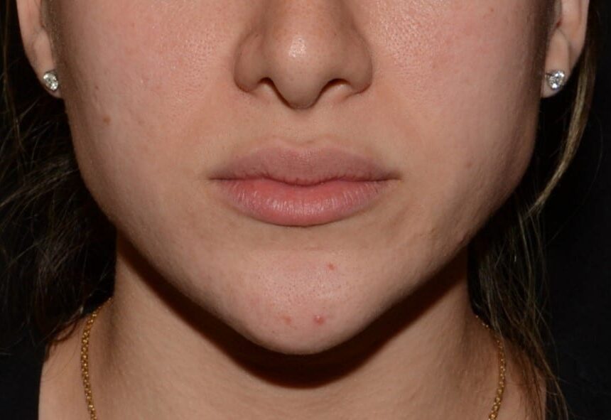 Before Image: Lip Flip - front