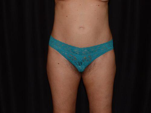 After Image: CoolSculpting - front