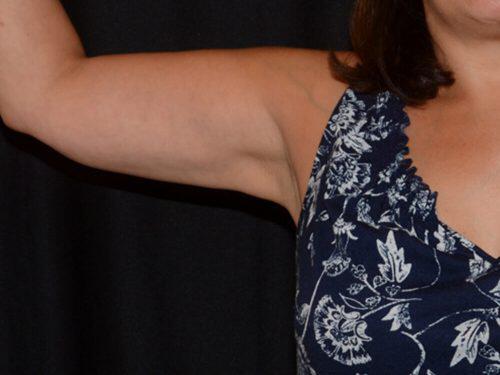 After Image: CoolSculpting - front