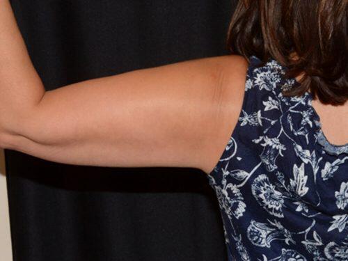 After Image: CoolSculpting - back