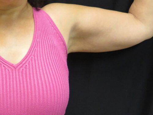 Before Image: CoolSculpting - front