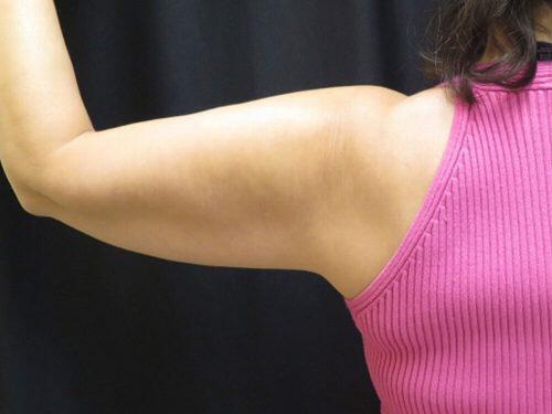 Before Image: CoolSculpting - back