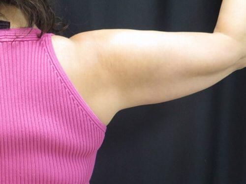 Before Image: CoolSculpting - back