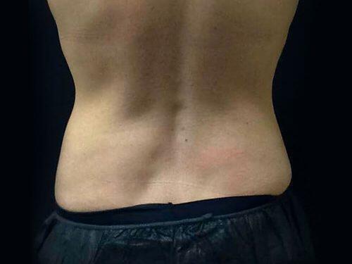 After Image: CoolSculpting - back