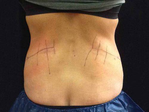 Before Image: CoolSculpting - back