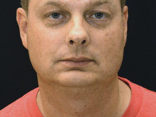 After Image: CoolSculpting - front