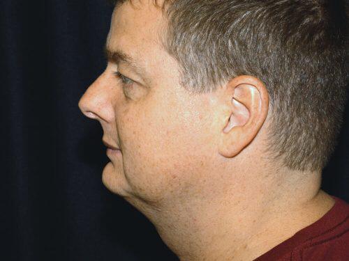 After Image: CoolSculpting - left-side