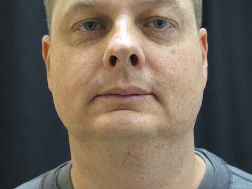 Before Image: CoolSculpting - front