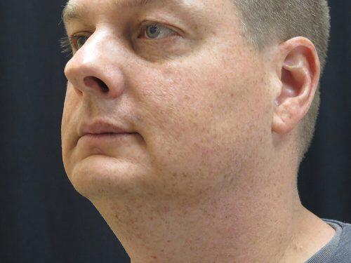 Before Image: CoolSculpting - left-front-oblique