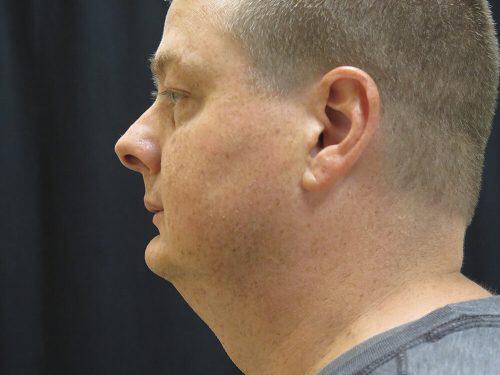 Before Image: CoolSculpting - left-side