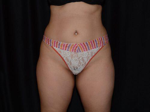 After Image: CoolSculpting - front