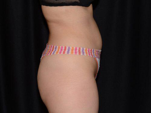 After Image: CoolSculpting - right-side