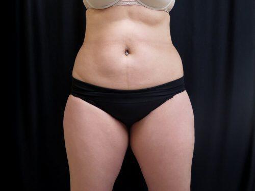 Before Image: CoolSculpting - front