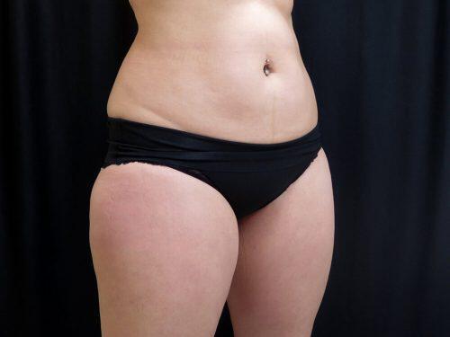 Before Image: CoolSculpting - right-front-oblique