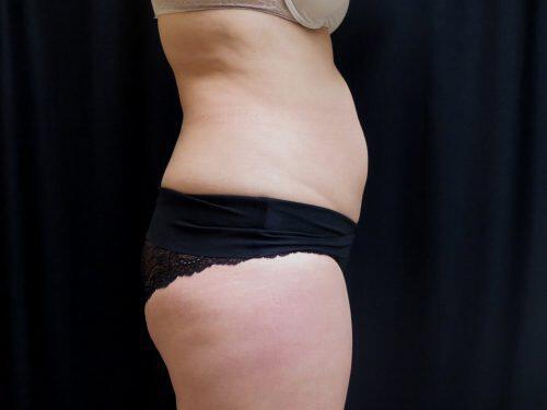 Before Image: CoolSculpting - right-side