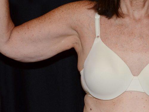 After Image: CoolSculpting - front