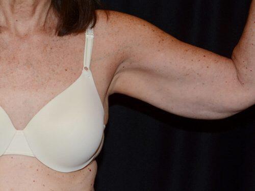 After Image: CoolSculpting - front