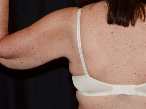 After Image: CoolSculpting - back