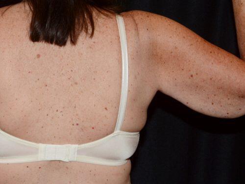 After Image: CoolSculpting - back