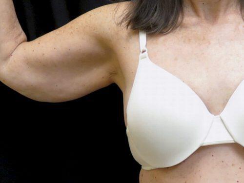 Before Image: CoolSculpting - front