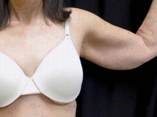 Before Image: CoolSculpting - front