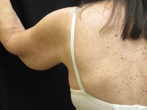 Before Image: CoolSculpting - back