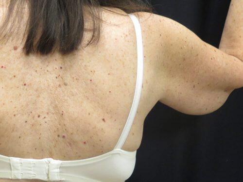 Before Image: CoolSculpting - back