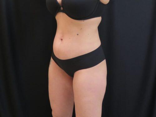 After Image: CoolSculpting - left-front-oblique