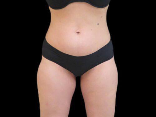 After Image: CoolSculpting - front