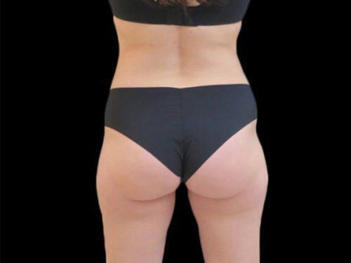 After Image: CoolSculpting - back