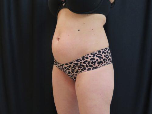 Before Image: CoolSculpting - left-front-oblique