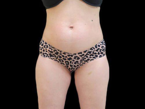 Before Image: CoolSculpting - front