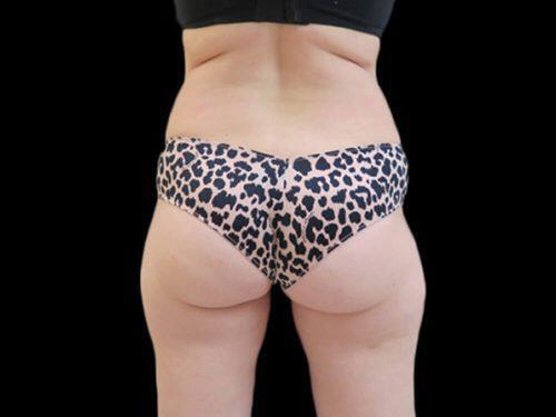 Before Image: CoolSculpting - back