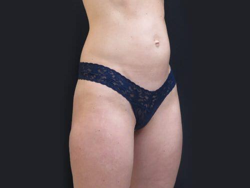 Before Image: CoolSculpting - right-front-oblique