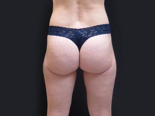 Before Image: CoolSculpting - back