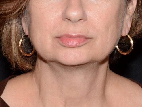 After Image: CoolSculpting - front