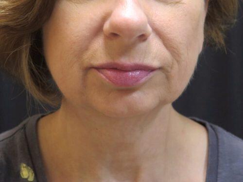 Before Image: CoolSculpting - front