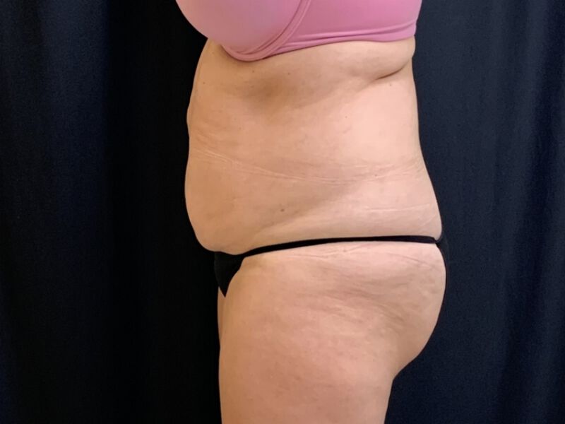 After Image: CoolSculpting - left-side