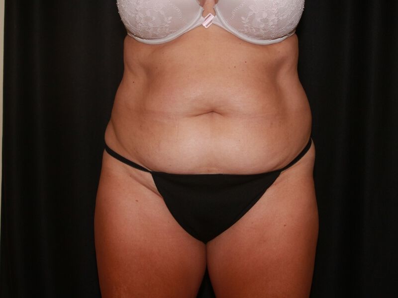 Before Image: CoolSculpting - front