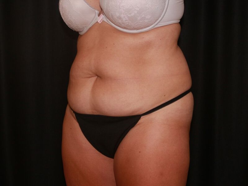 Before Image: CoolSculpting - left-front-oblique