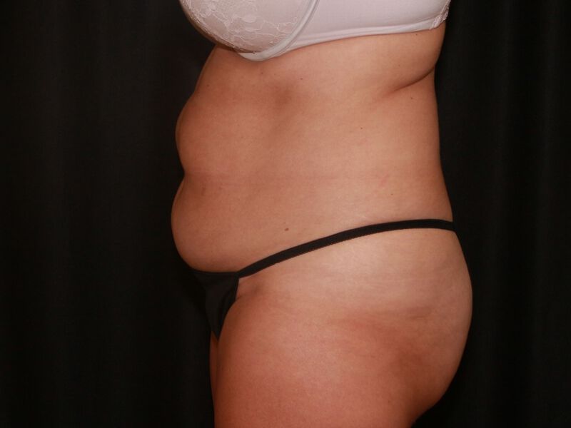 Before Image: CoolSculpting - left-side