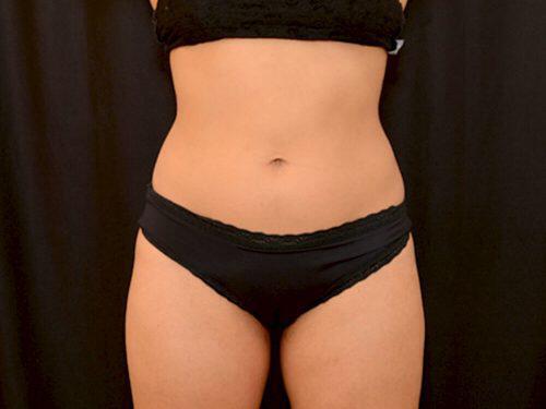 After Image: CoolSculpting - front
