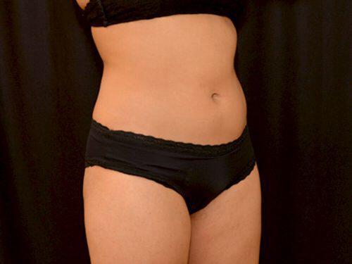 After Image: CoolSculpting - right-front-oblique
